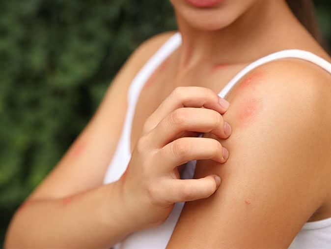 mosquito bites on maine resident's arm