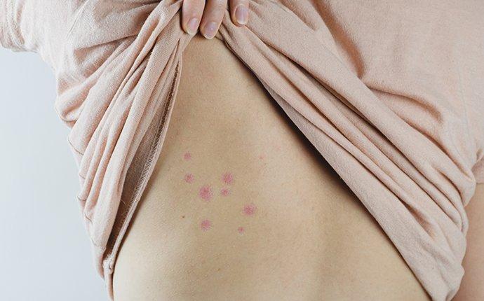 bed bug bites on someones side