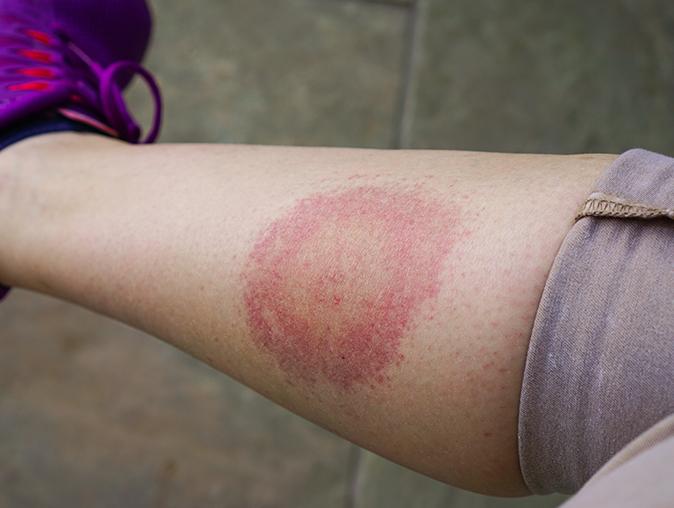 Learn More About The Diseases That Are Commonly Spread By Ticks In New Jersey tick embedded in a human scalp